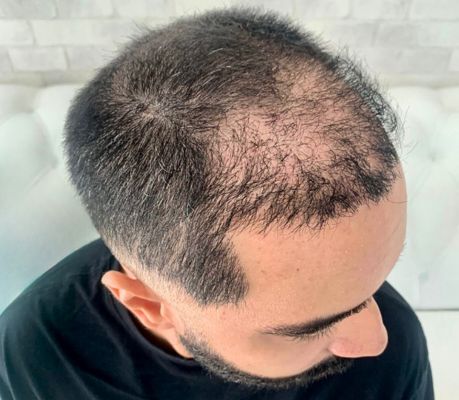 Antes da micropigmentação na área doadora FUE