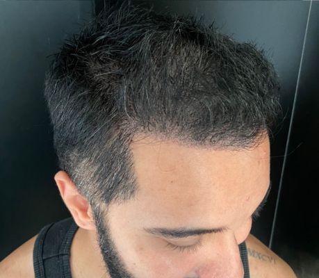 Resultado depois da micropigmentação na área doadora FUE