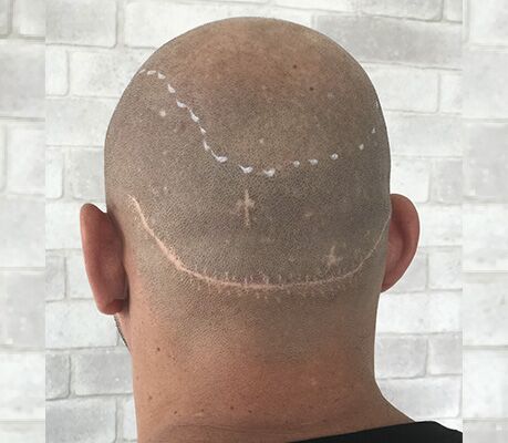 Antes da micropigmentação capilar para cicatriz