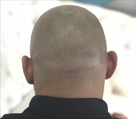 Resultado depois da micropigmentação capilar para cicatriz