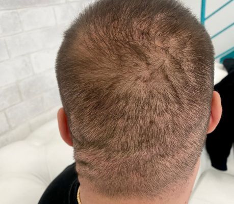 Antes da micropigmentação para densidade em transplante