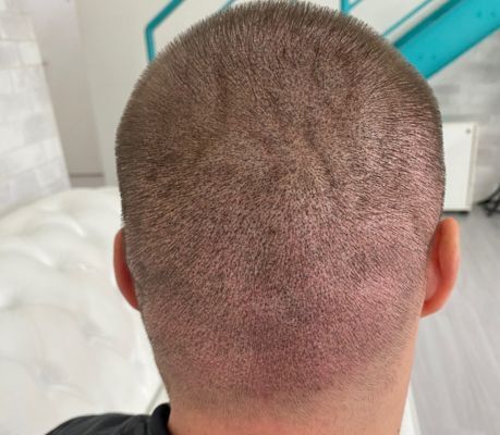 Resultado depois da micropigmentação para densidade em transplante