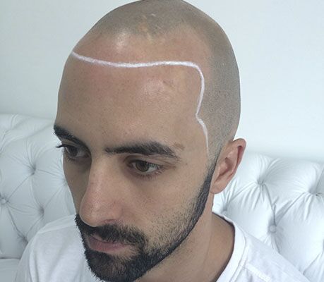 Antes da micropigmentação capilar nas entradas