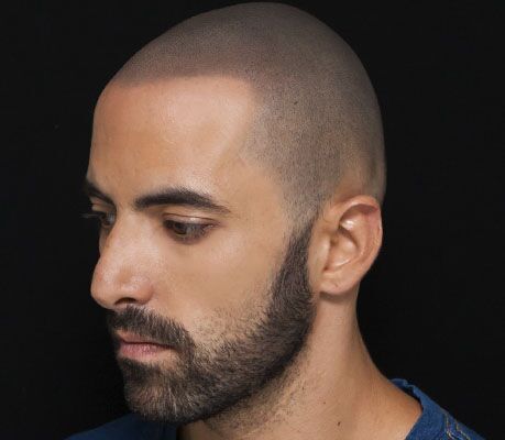 Resultado depois da micropigmentação capilar nas entradas