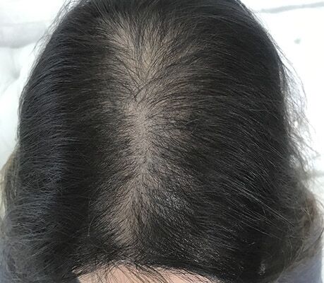 Antes da micropigmentação capilar feminina
