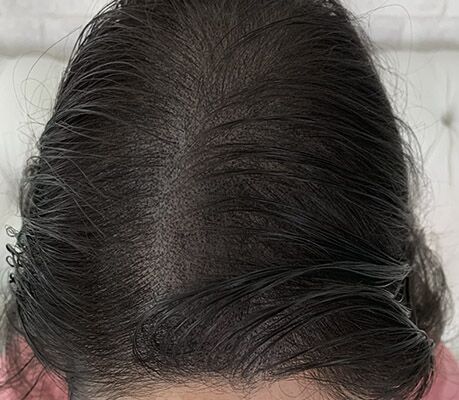 Resultado depois da micropigmentação capilar feminina