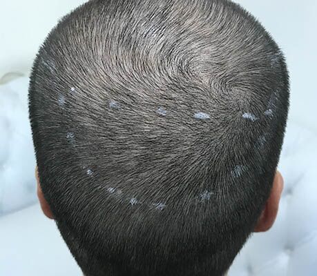 Antes da micropigmentação para queda de cabelo