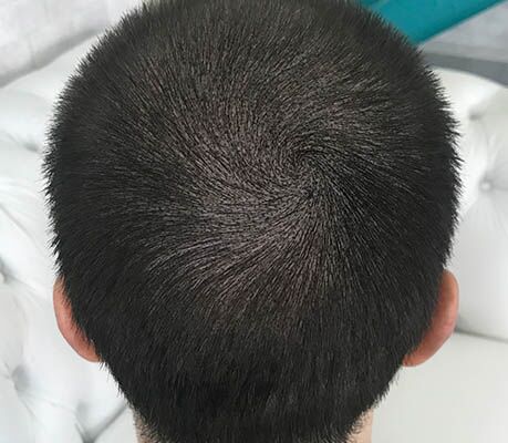 Resultado depois da micropigmentação para queda de cabelo