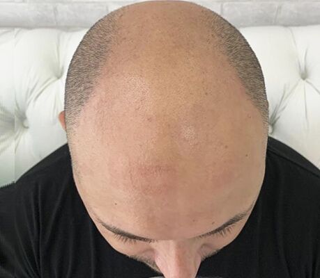 Antes da micropigmentação capilar