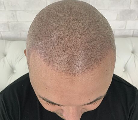 Resultado depois da micropigmentação capilar